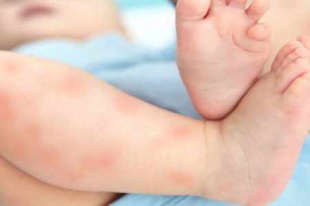 Que Faire En Cas D Eczema Du Bebe Quels Soins Appliquer Que Faire En Cas D Eczema Du Bebe Quels Soins Appliquer